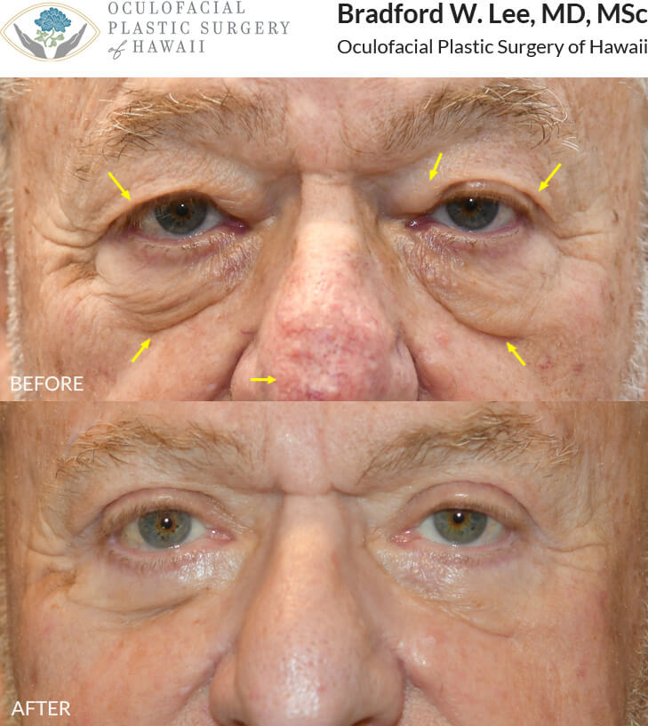 This patient was bothered by excess skin on his eyelids and the droopiness of his upper eyelids, which affected his driving and reading. He underwent an upper and lower (quad) blepharoplasty with a brow lift to remove the excess skin and fat and lift the brows to improve his vision and overall appearance. He also opted for a CO2 laser treatment to address his rhinophyma (a skin disorder that causes the nose to enlarge and become red, bumpy, and bulbous).