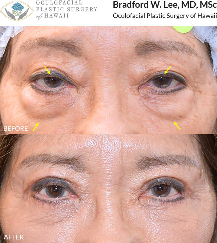 This patient was bothered by the drooping of her upper eyelids and the puffiness of the lower eyelids. She underwent an upper and lower (quad) blepharoplasty with a ptosis repair to remove the excess skin and fat on the eyelids and improve her vision.