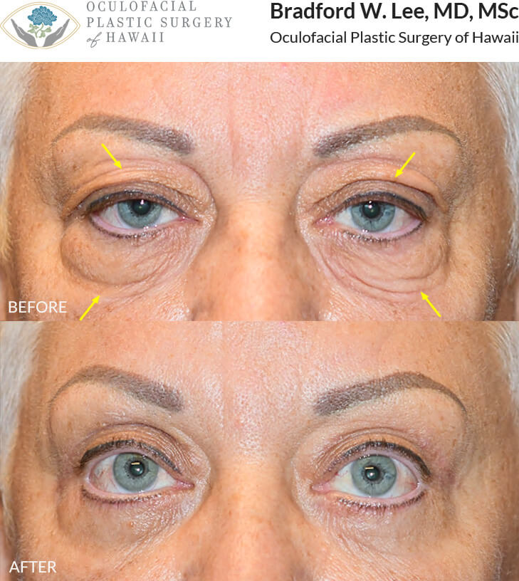 This patient was bothered by the drooping and excess skin of her upper and lower eyelids. She underwent an upper and lower (quad) blepharoplasty with a ptosis repair to remove the excess skin and fat on the eyelids and improve her vision.