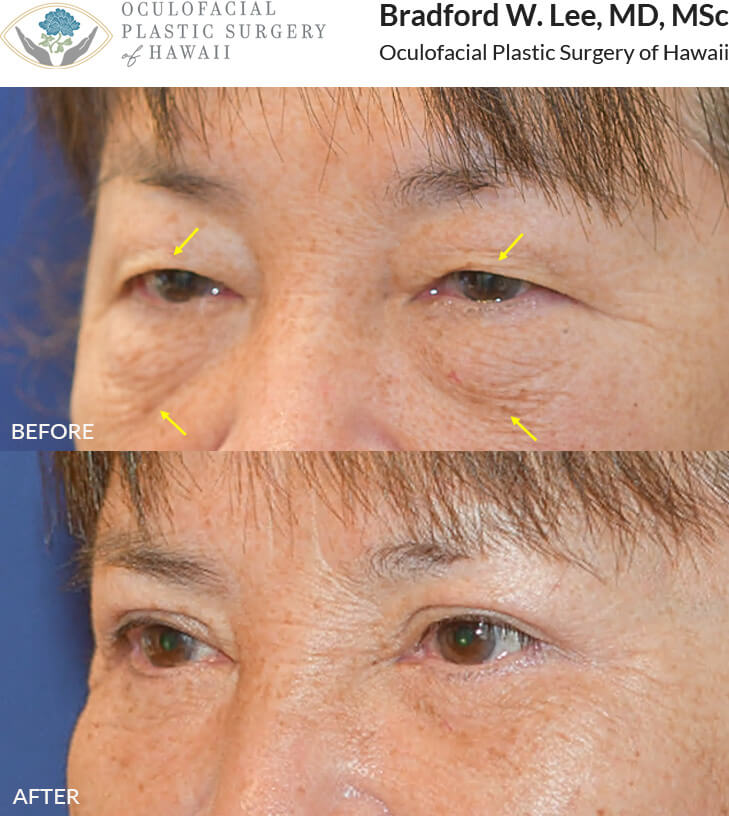 This patient noticed that her droopy upper eyelids were causing shadowing, making it difficult to see. She chose to undergo an upper blepharoplasty to improve her vision and a lower blepharoplasty to remove excess skin and fat from her lower eyelids, resulting in a more youthful and refreshed appearance. *This photo was taken at 3 months post-op, and the mild residual redness/swelling on the upper lids will continue to resolve over time.*