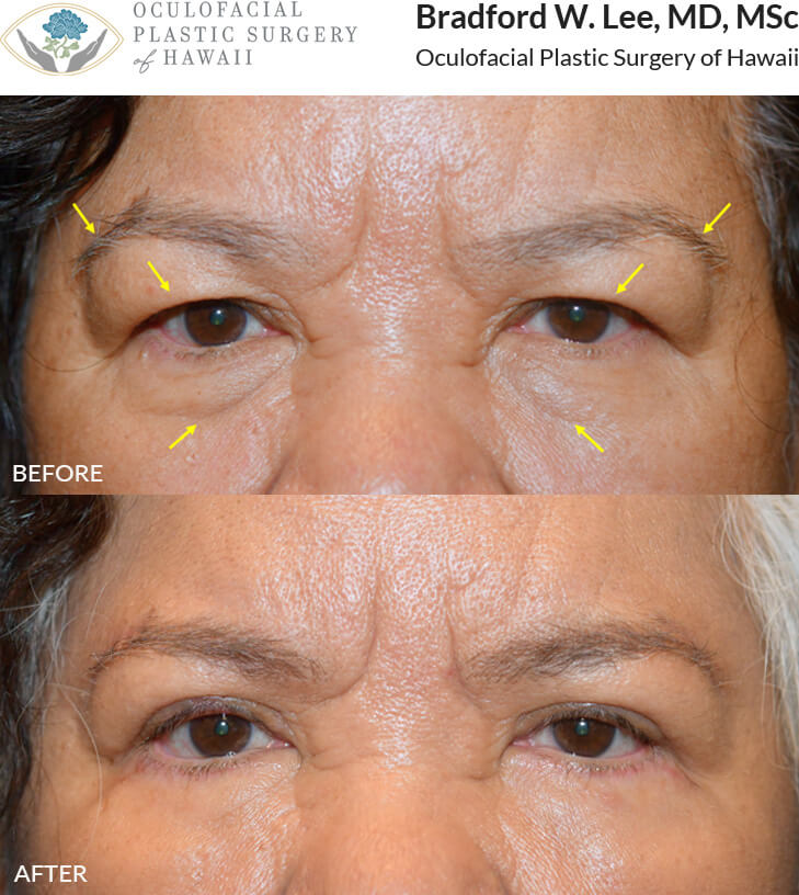 This patient was concerned about the excess skin on her upper and lower eyelids, which she noticed was affecting her vision. She underwent an upper blepharoplasty with a brow lift to improve her vision and a lower blepharoplasty to remove the excess skin and fat in the under-eye area.