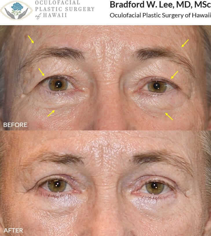 This patient was bothered by the droopiness of her upper eyelids and the puffiness of her lower eyelids. She underwent an upper and lower (quad) blepharoplasty along with a trichophytic brow lift to remove the excess skin and fat on her eyelids and increase her eyelid aperture. *This photo was taken at 3 months post-op, and the mild residual redness/swelling on the upper lids will continue to resolve over time.*