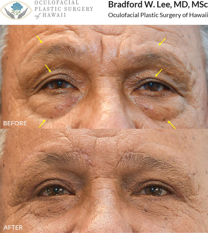 This patient was bothered by the drooping of his upper eyelids which interfered with his daily activities such as seeing and driving. He underwent an upper and lower (quad) blepharoplasty to remove the excess skin on the eyelids with a ptosis repair and brow lift to improve his vision.