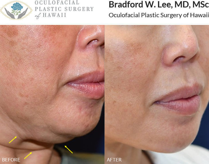 This 48-year-old patient was bothered by the fullness in the neck region and sought a more sculpted, defined jawline. She underwent a neck lift with submental liposuction to remove the fat from under the chin and contour the jawline.