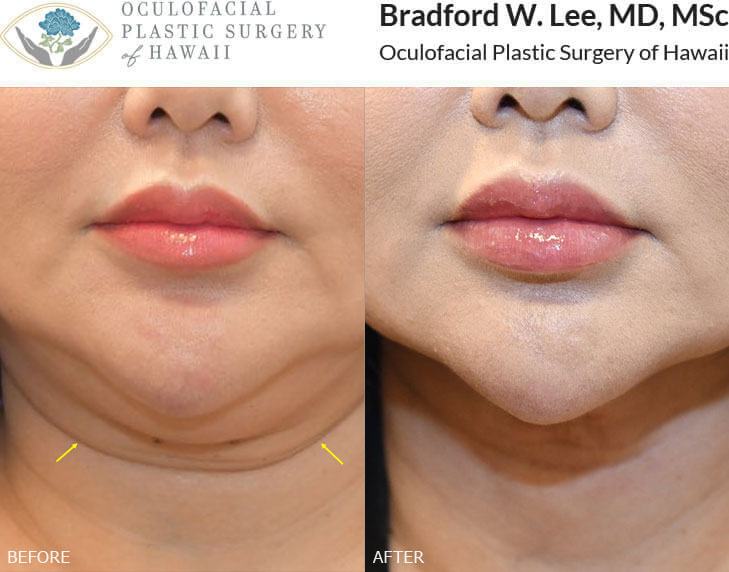 This 50-year-old patient was bothered by fullness in the neck region and wanted to have a sleeker, more contoured neck and jawline. She underwent a neck lift with neck liposuction to create beautiful definition to her neck and jawline.