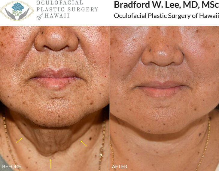 This 64-year-old patient was bothered by fullness and excess skin in the neck region and wanted a more defined jawline. She underwent a neck lift with submental liposuction to remove the excess skin and fat, giving her a more contoured neck and jawline.