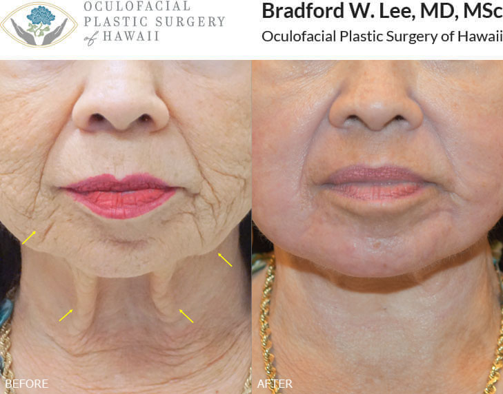 This 77-year-old patient was bothered by deep textural wrinkles on the face as well as gravitational changes and laxity of the midface, jowl, and neck region. She underwent a face and neck lift with 2 sessions of CO2 laser skin resurfacing to smoothen and brighten the skin while also restoring more youthful contours to the face, neck, and jawline.