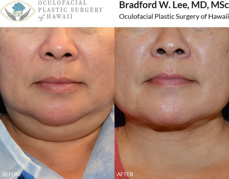 This patient was bothered by excess neck fat causing a “double chin.” She underwent a neck lift with liposuction to achieve a more sculpted neck and jawline.