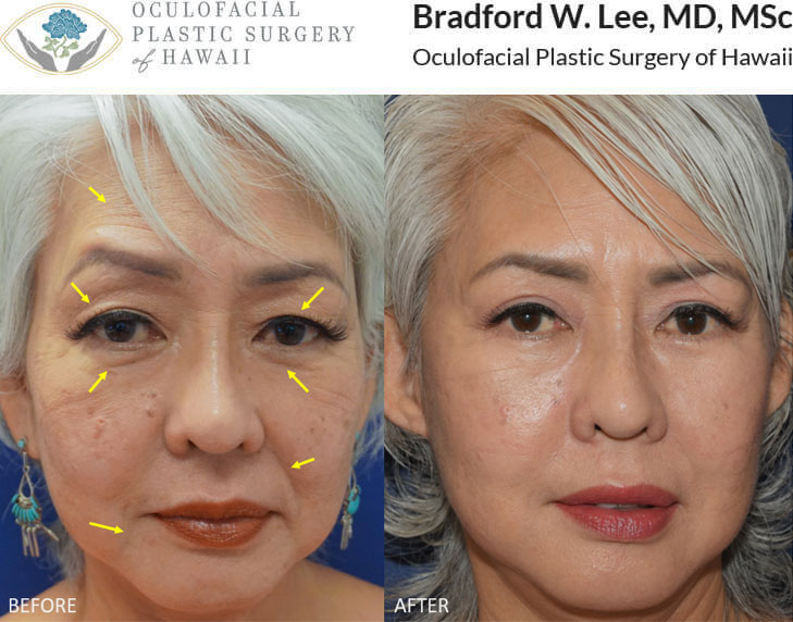 This 60+ year-old lady was bothered by excess skin on the upper and lower eyelids as well as mid-face descent, and mild jowling. She underwent a quad blepharoplasty, upper lid ptosis repair, and mini-facelift to restore a more youthful appearance to the eyes and face.