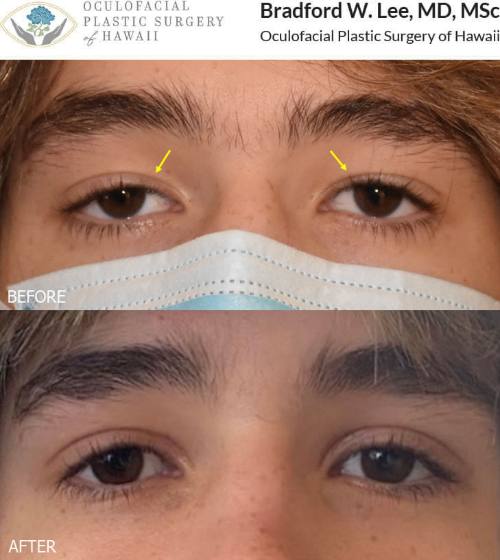 This 18-year-old man was bothered by drooping of the upper eyelids and a low eyelid crease with mild excess skin. He underwent a conservative upper blepharoplasty and ptosis repair to subtly open his eyes and create a higher and more defined upper eyelid crease.