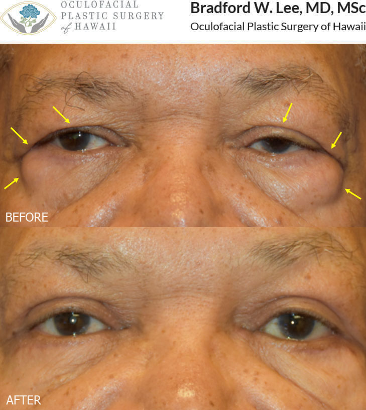 This 70-year-old man presented with ptosis of the left upper eyelid, excess skin on the upper lids, lateral brow ptosis, and prominent fat prolapse on the lower eyelids. He underwent a left upper lid ptosis repair, bilateral internal browpexy, and quad blepharoplasty to open his left eye, support the tail of the brows, and remove the excess skin and fat on the upper and lower eyelids.