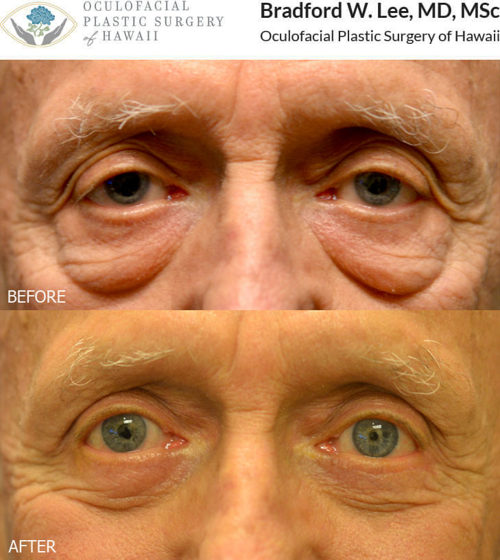 This 75-year-old man was bothered by excess folds and creases of skin on the upper eyelids and prominent “bags” on the lower eyelids. He underwent upper and lower blepharoplasty for a natural and age-appropriate enhancement of the upper and lower eyelids.