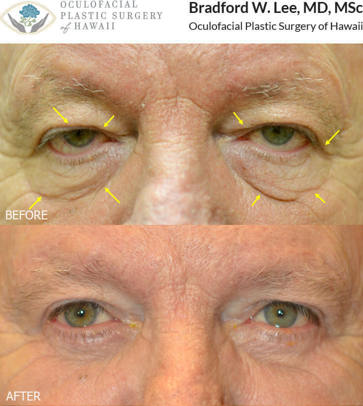 This 74-year-old man was bothered by upper lid ptosis, sagging of the lower eyelids, and excess skin on the upper and lower eyelids. He underwent a bilateral upper lid ptosis repair with quad blepharoplasty to raise both upper eyelids and remove excess skin and tighten the eyelids. This resulted in a brighter and enhanced appearance of the eyes while maintaining a natural appearance.