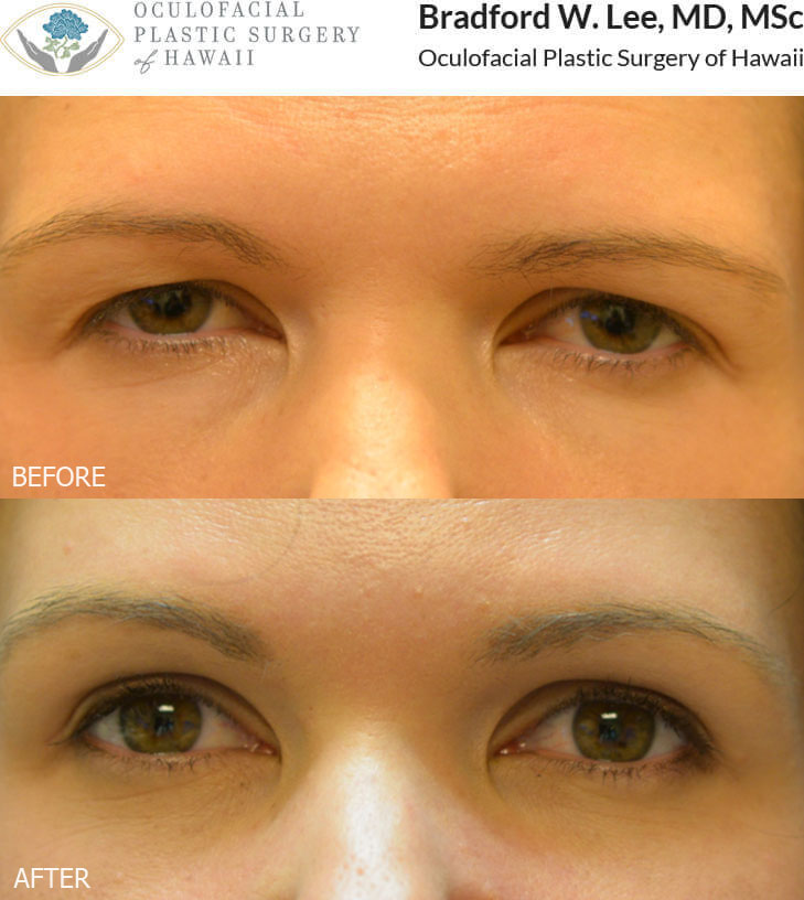 This 38-year-old lady was bothered by drooping of the upper eyelids and brows resulting in a tired and forlorn appearance. She underwent an upper blepharoplasty and brow and forehead lift resulting in an improved appearance and expression of her eyes.