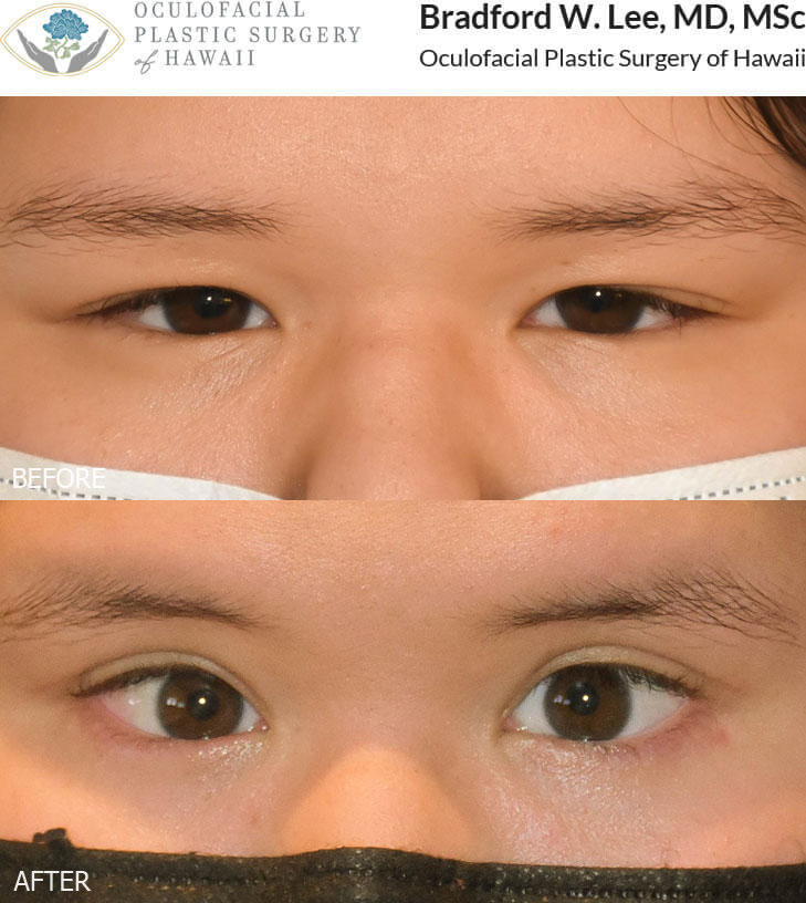 This 16-year-old Asian/Latina patient was bothered by her squinty eyes, heavy upper eyelids, and lower lids with lashes that curled inwards and rubbed on her corneas. She underwent an Asian upper blepharoplasty and lower lid epiblepharon repair to open the eyes, improve the visibility of her eyelid crease, and rotate the lashes on the lower eyelids away from the eyes.