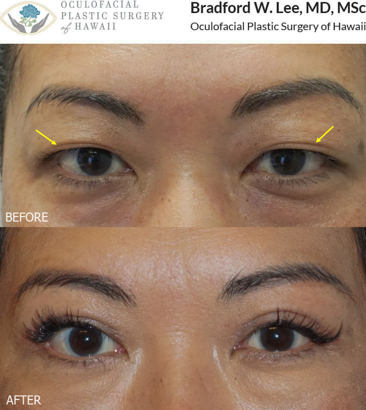 This 40+ year-old Asian lady was bothered by excess upper eyelid skin, heavy upper lids, and a low upper eyelid crease that covered the platform of the upper eyelid. She underwent an Asian blepharoplasty to remove excess skin, define a more prominent upper lid crease, and improve the visibility of the upper eyelid platform.