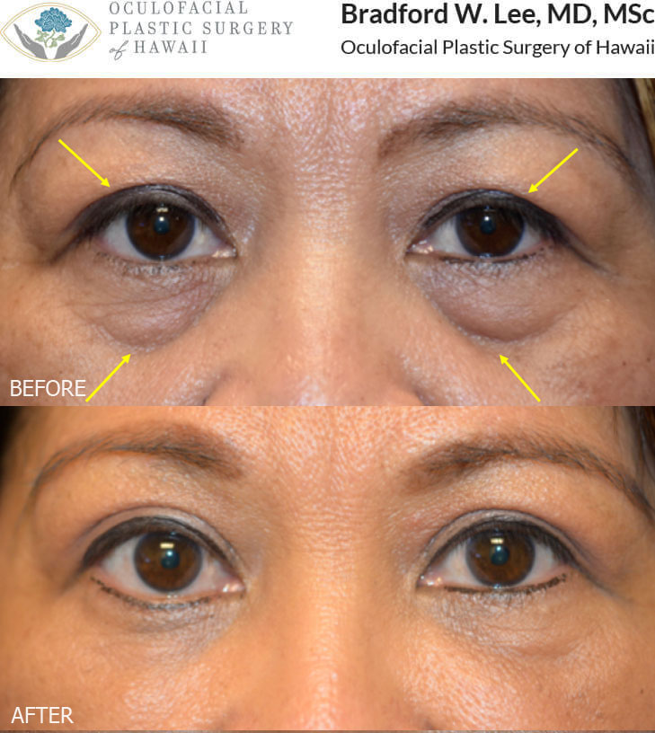 This 52-year-old Asian lady was bothered by excess skin covering her eyelid crease, a smaller aperture of the left eye, and dramatic hollowing along the lower lids into the cheek. She underwent a left ptosis repair, upper blepharoplasty, and liposuction with fat transfer to the lower eyelids to improve the symmetry of the eye apertures, improved definition of the upper lid creases, and a rejuvenated appearance to the lower eyelids.