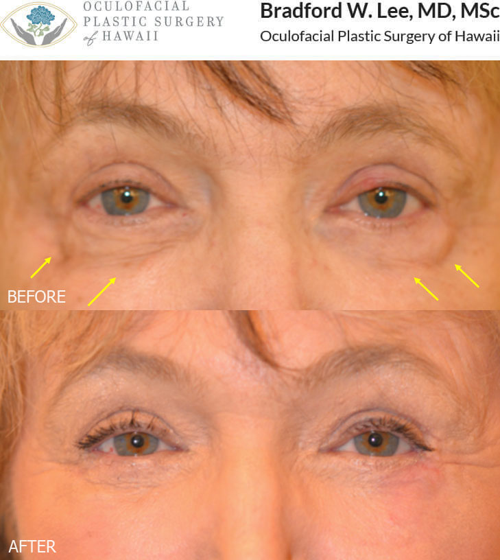 This 60+ year-old lady saw a general plastic surgeon who performed fat transfer to the lower lids that resulted in bulging lumps of fat on the lower eyelids without improvement in her lower lid hollowing. She underwent a revision procedure with Dr. Lee, including a lower blepharoplasty with fat repositioning, liposuction with fat transfer to the under eye region, and laser skin resurfacing for a smoother, more youthful contour to the lower eyelids.