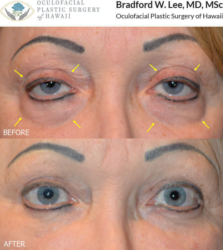 This 62-year-old lady underwent a quad blepharoplasty with a general plastic surgeon but was bothered by the uncorrected eyelid ptosis that made her eyes look sleepy and half closed, residual excess skin on the upper eyelids, and fat prolapse and hollowing under the eyes. She underwent a 4-lid blepharoplasty with fat repositioning, liposuction with fat transfer to the lower lids, and laser resurfacing resulting in a more alert and youthful appearance to the upper and lower eyelids.