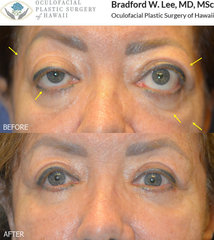 This 60+ year-old lady with thyroid eye disease was bothered by the bulging of her eyes, lower eyelid retraction, excess skin on both upper and lower eyelids, and age-related atrophy of the temples, under eye region, and cheeks. She underwent bilateral orbital decompression surgery, eyelid retraction repair, quad blepharoplasty, and fat transfer to the temples, cheeks, and lower lids to reduce the bulging of the eyes, improve the position and symmetry of the eyelids, and restore youthful facial contours in the periocular region.