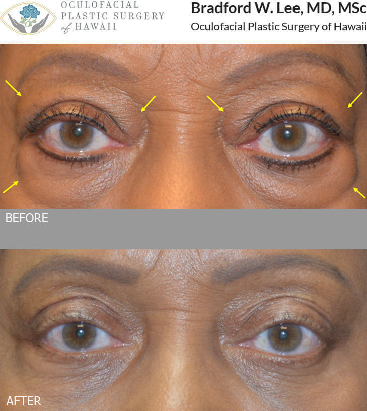 This 67-year-old lady had a history of thyroid eye disease and was bothered by prominent excess fat and skin on the upper and lower eyelids. She underwent a bilateral upper and lower blepharoplasty with orbital fat decompression that subtly improved the bulging of the eyes, softened her expression, and rejuvenated the upper and lower eyelids.