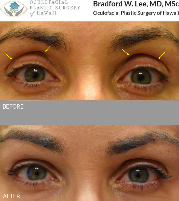 This 51-year-old lady was bothered by hollowing of the upper lids and vertical elongation of the upper eyelid platform that gave her an aged appearance. She underwent dermal filler injections to the superior sulcus resulting in improvement of the hollowing, reduced upper eyelid platform show, and a more alluring and youthful contour to the upper eyelids.