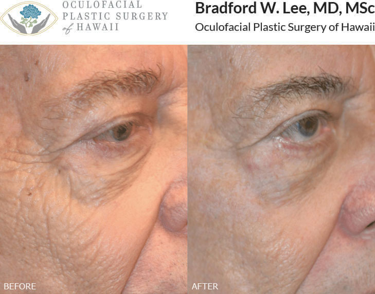 This 60+ year-old male presented with deep wrinkles and textural changes of the cheek. He had 1 session of CO2 laser resurfacing to tighten the skin and smooth the wrinkles and textural changes.