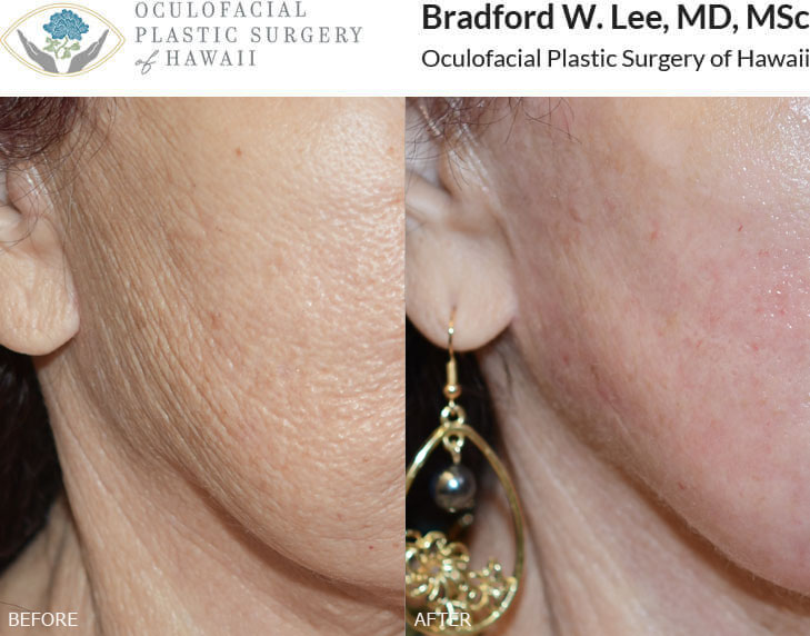 This 77-year-old patient was bothered by deep wrinkles and textural skin changes and was looking for a dramatic way to rejuvenate the skin. She had two sessions of CO2 laser resurfacing and was able to achieve smoother, more radiant skin that helped stimulate collagen and removed years of sun damage.