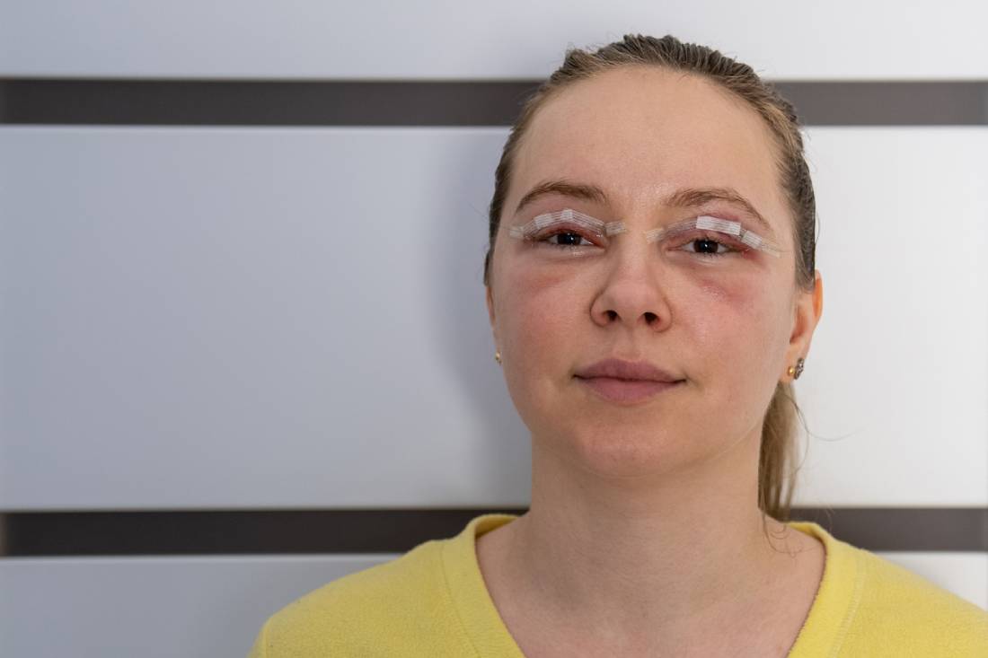 Featured image for How Long Is Recovery from Eyelid Surgery?