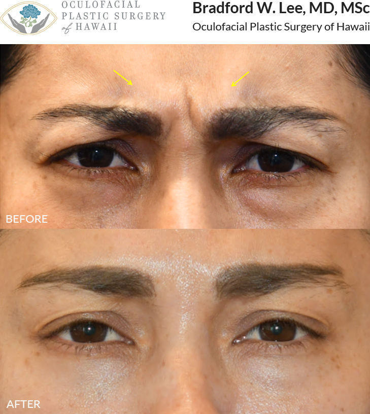 This patient was looking to do preventative botox for her frown lines or “11 lines.”