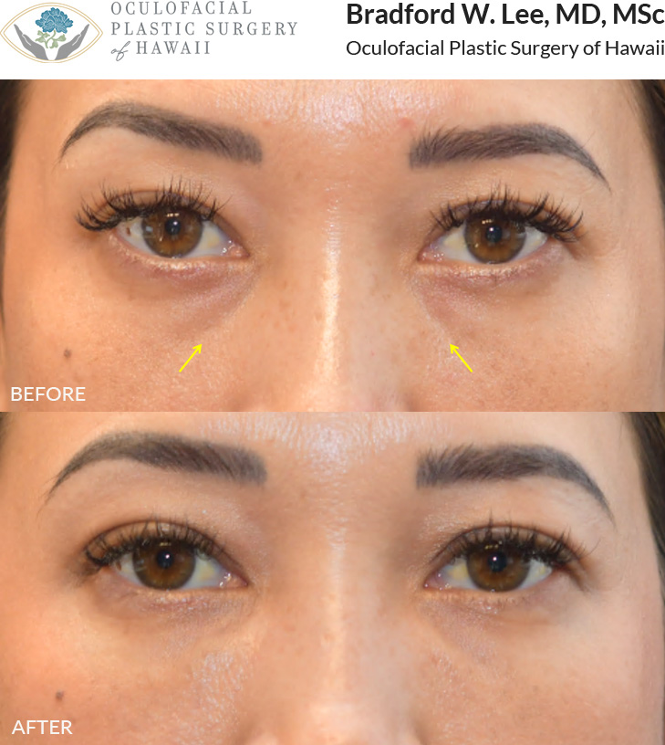 This patient was concerned about the hollowing under her eyes and chose tear trough filler to achieve a smoother, more refreshed appearance.