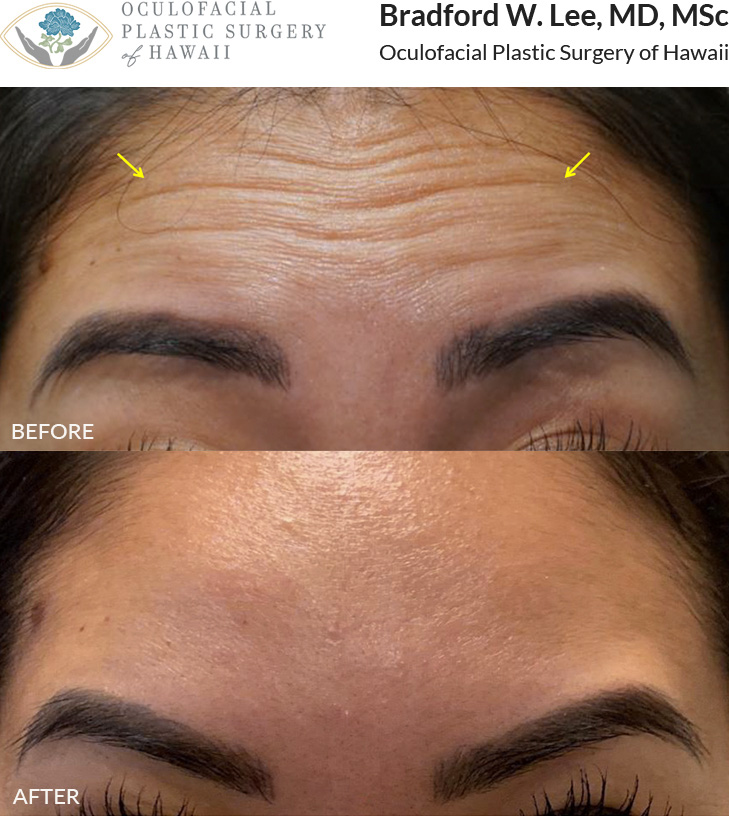 This patient was looking to do some preventative neuromodulators injections and was bothered by the dynamic wrinkles on her forehead.