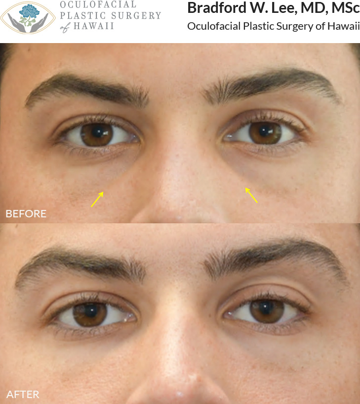 This patient wanted to address the hollowing under her eyes and opted for tear trough filler to restore volume and create a more youthful, refreshed look.