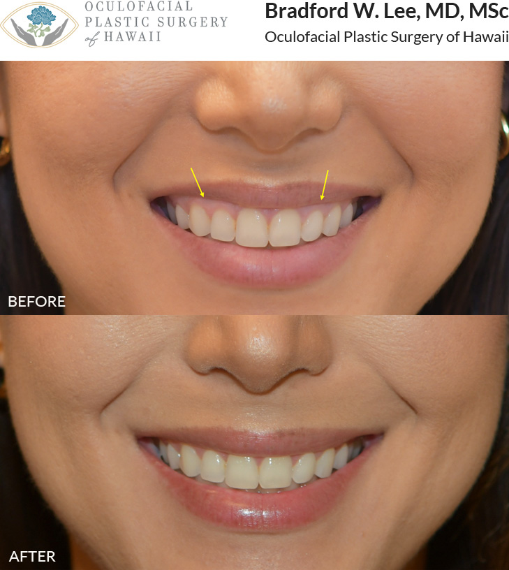 This patient was bothered by her “gummy smile” and had neuromodulators treatment to her lip elevating muscles to reduce the amount of gum show. 