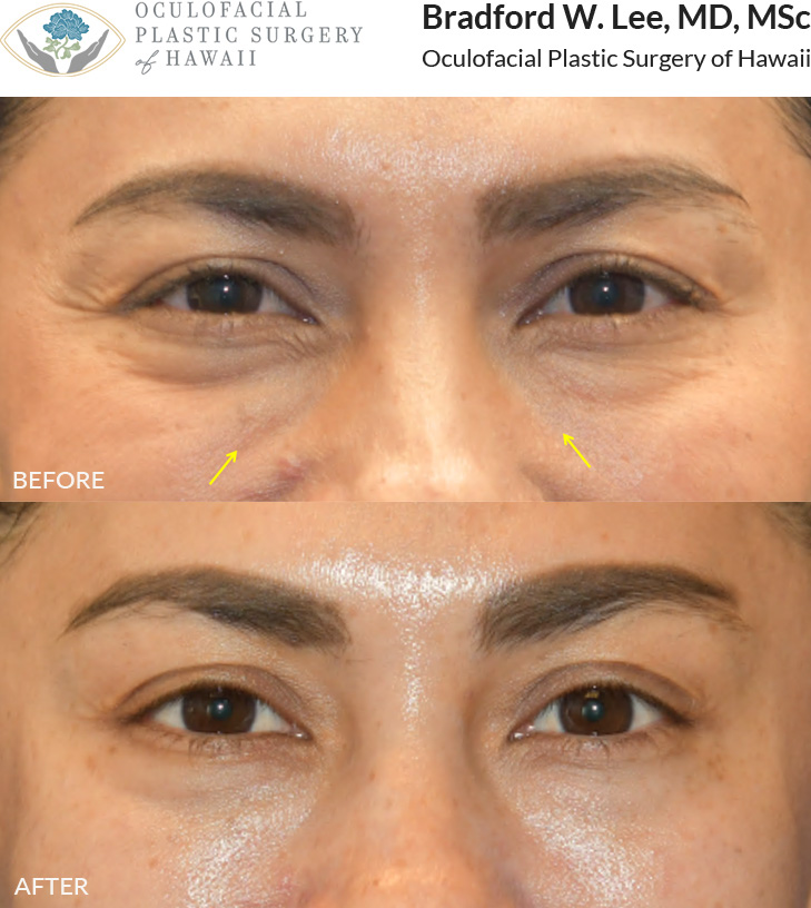 This patient was concerned about the hollowing under her eyes and chose tear trough filler to restore volume and achieve a refreshed, smoother appearance.