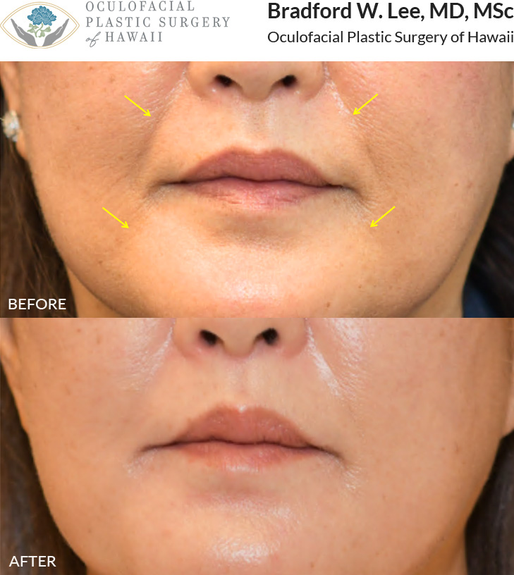 This patient was concerned about facial volume loss and was looking for a natural looking enhancement. She chose a dermal filler treatment for her nasolabial folds and marionette lines, resulting in a more youthful and refreshed appearance.