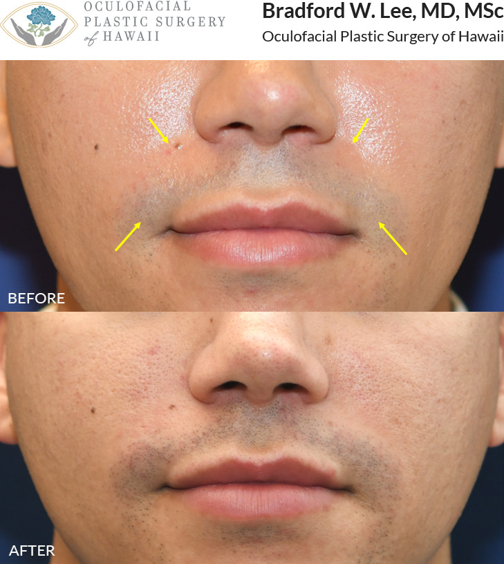 This patient was bothered by the hollowing in his nasolabial folds and around his mouth. He chose a dermal filler treatment to restore volume and soften his appearance