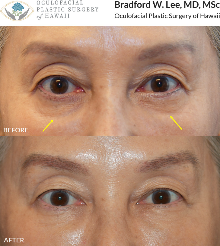 This patient was bothered by hollowing and dark circles under her eyes. She had filler to the tear trough region with improvement in the hollows and dark circles and a more youthful contour to her lower eyelids.