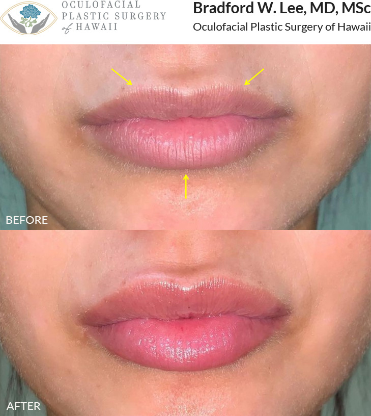 This patient wanted more volume in the upper lip and was concerned about its vertical wrinkles. With lip filler, she achieved both the desired volume and a smoother appearance.