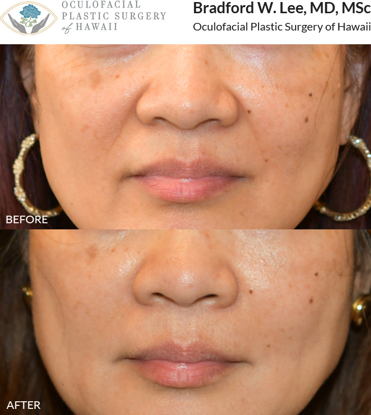 This patient was concerned about facial volume loss and chose dermal filler treatment for her nasolabial folds and marionette lines, resulting in a more youthful and refreshed appearance.