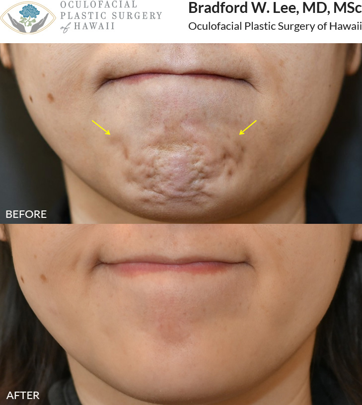 This patient was looking to smooth the appearance of her “pebble chin” and had neuromodulators to address this.