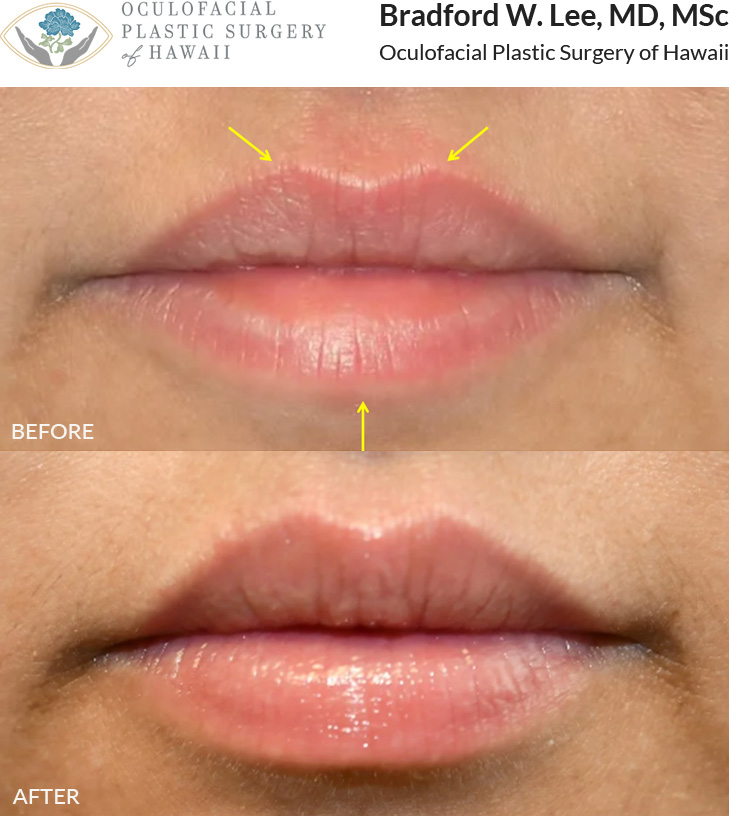 This patient desired a natural enhancement of the lips and chose dermal filler to add volume and provide hydration.