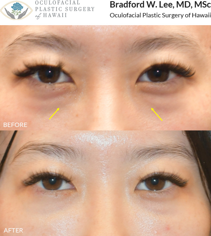 This patient was bothered by the hollowing of her under eye region and opted for tear trough filler to restore volume and soften her appearance.