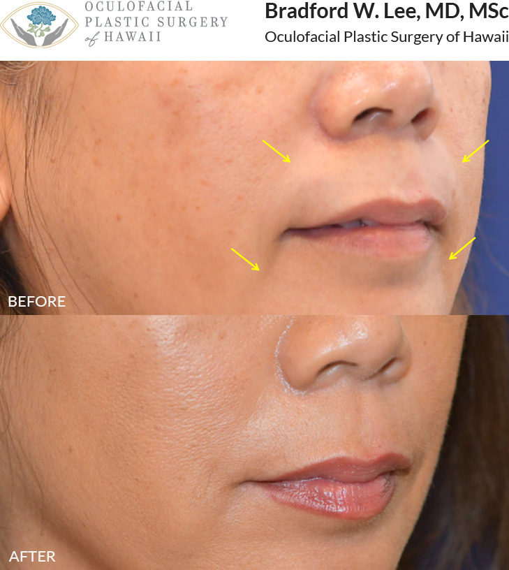 This patient was bothered by facial volume loss and her smile lines. She opted for dermal filler treatment in her nasolabial folds and marionette lines, giving her a refreshed appearance.