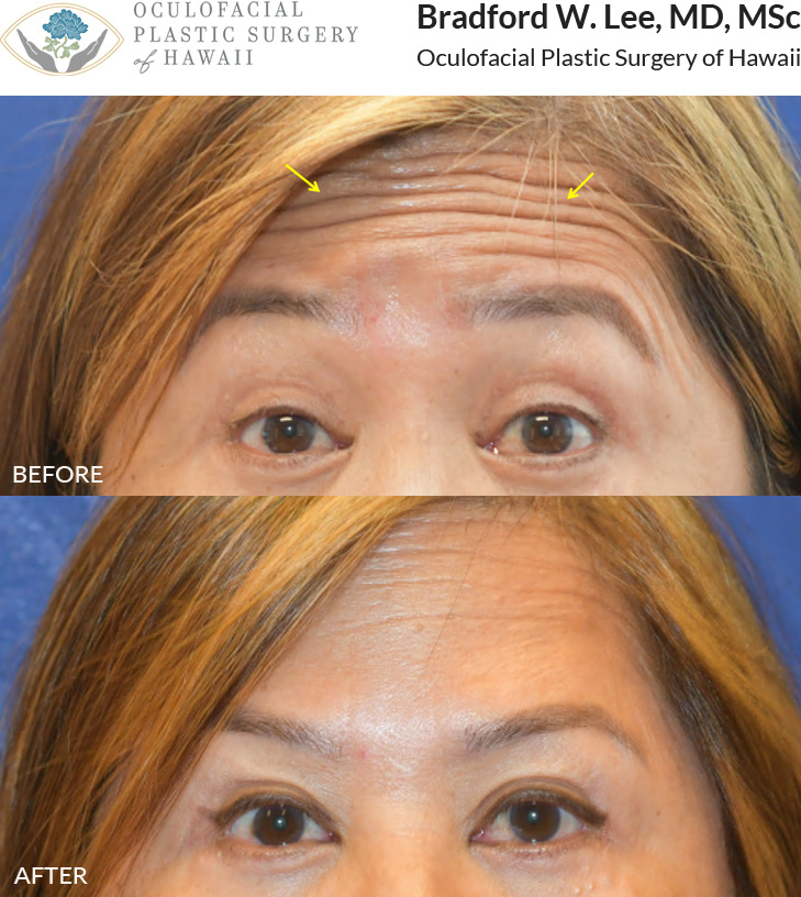 This patient was concerned about the wrinkles on her forehead but wanted to keep some natural movement in the area. She chose a conservative Neuromodulators treatment to smooth her skin's appearance while preserving some mobility.