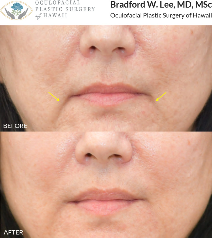 This patient was concerned about her frown lines and deep grooves in the marionette region. She opted for dermal filler treatment to restore volume and refresh her overall appearance.