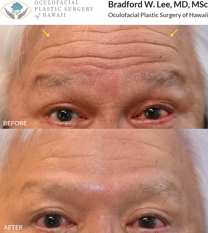 This patient was bothered by the wrinkles on his forehead but wanted to keep some natural movement in the area. He chose a conservative neuromodulators treatment to smooth his skin's appearance while preserving some mobility.