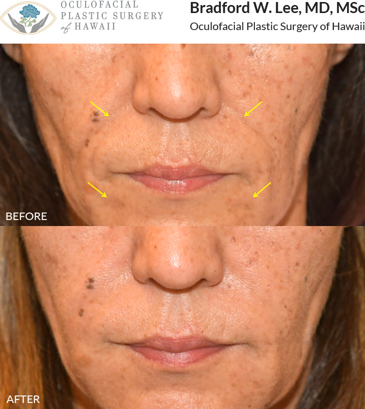 This patient was concerned about facial volume loss and chose dermal filler treatment for her nasolabial folds and marionette lines, resulting in a refreshed appearance.