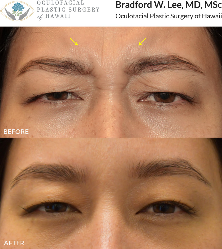 This patient was looking to soften the appearance of her dynamic frown lines or “11 lines.”