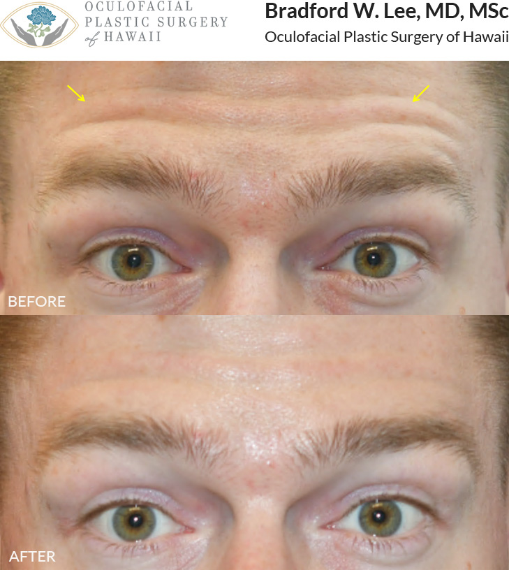 This patient was looking to soften the appearance of his dynamic forehead wrinkles while maintaining some natural movement.